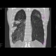 Bullous emphysema: CT - Computed tomography